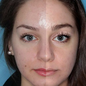 Latisse - Timeless Skin Solutions