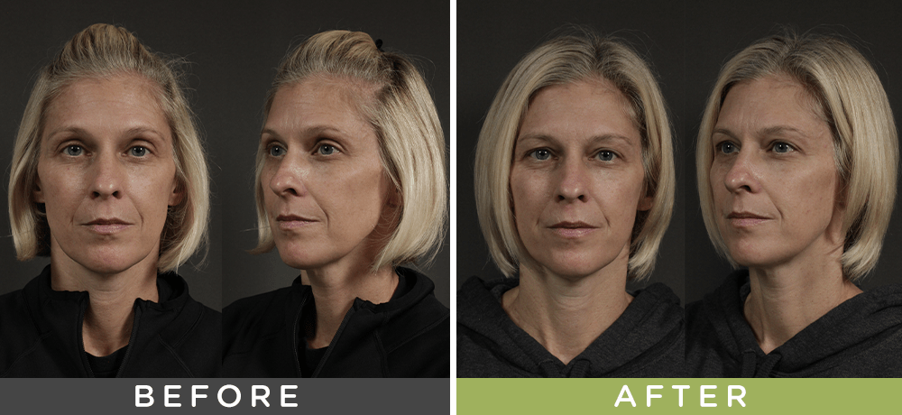 Before and after of the chemical peel process.