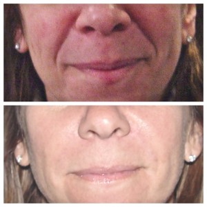 A liquid facelift before and after image.