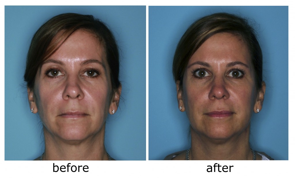 Kristy's liquid facelift before and after.