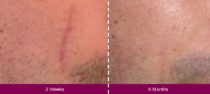 SkinMedica Scar Gel Before and After