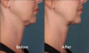 kybella-before-and-after-sm