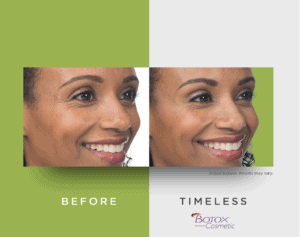 A Botox® before and after example.
