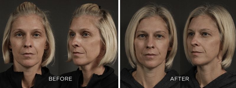 A before and after of a chemical peel.