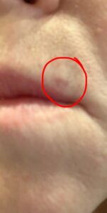 A red mark above Kathy's top lip on her left side. There is a red circle around the spot to highlight it.