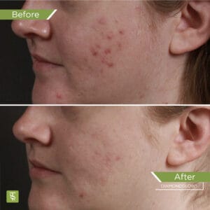 Before and After DiamondGlow Acne