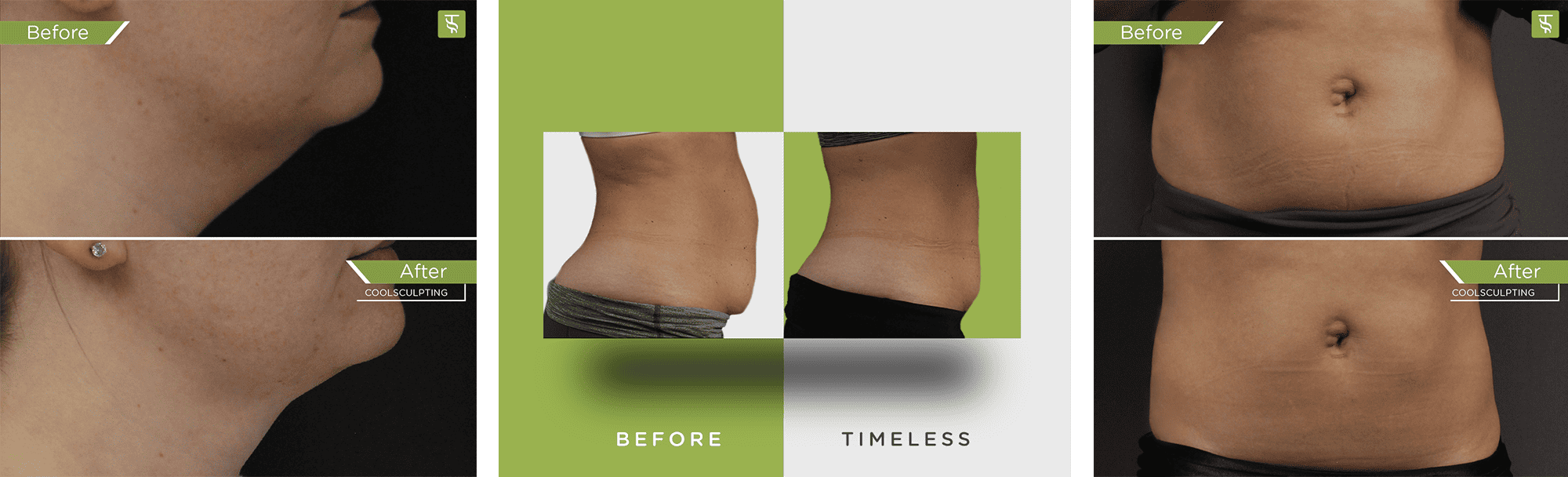 Before and After photos of coolsculpting 